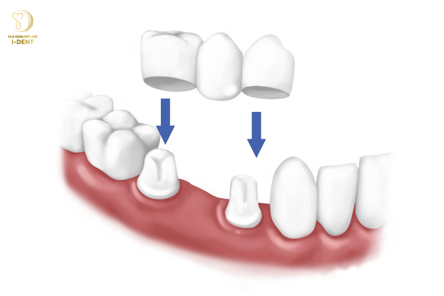 Trồng răng khểnh bằng cầu răng sứ 