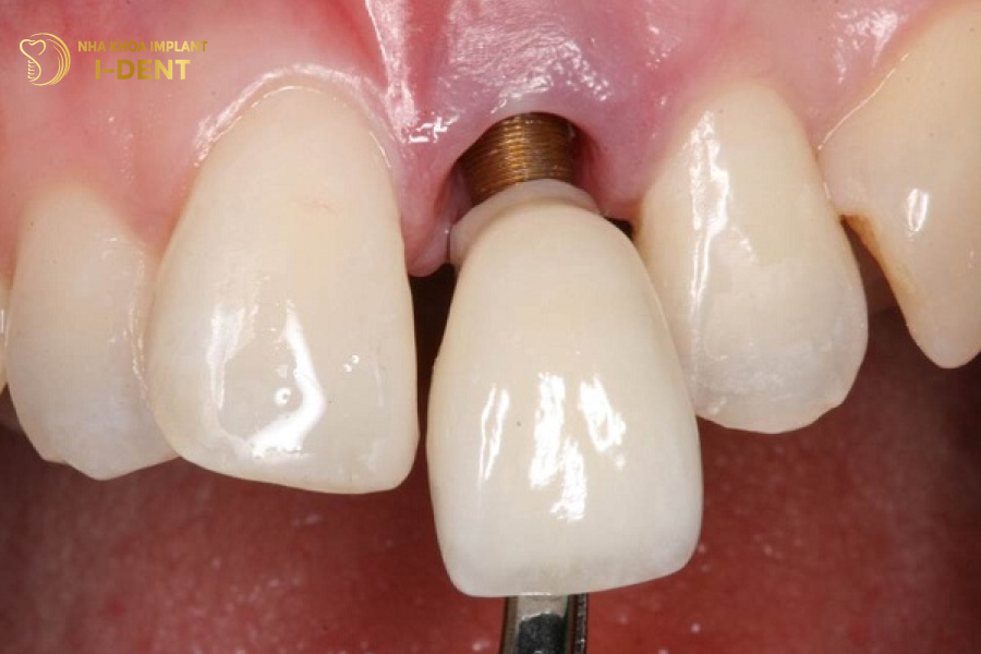 Trụ Implant bị gãy vít kết nối