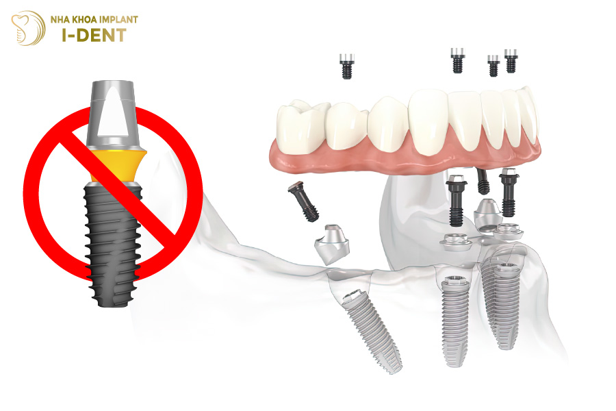 Trụ Implant Hàn Quốc không thể áp dụng cho những trường hợp mất răng toàn hàm