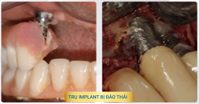 Trụ Implant kém chất lượng dễ bị toét, nứt, gãy