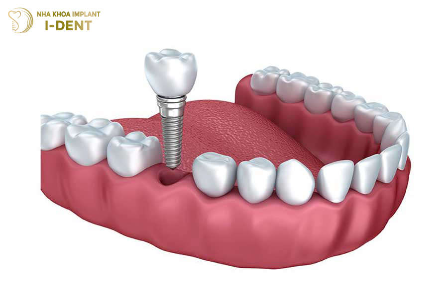 Trụ Implant sẽ thay thế chân răng và kích thích xương hàm phát triển