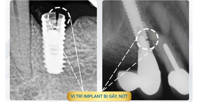 Trụ Implant kém chất lượng dễ bị toét, nứt, gãy