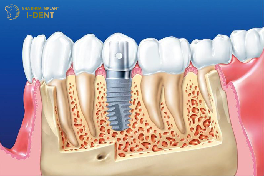 Trụ Implant thay thế cho chân răng thật và ngăn chặn tiêu xương