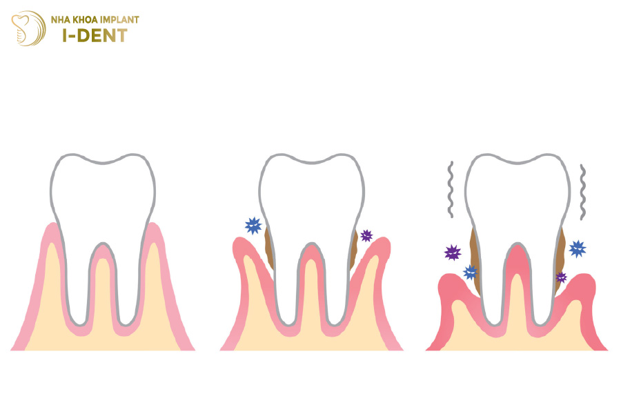 Tụt lợi khiến cho chân răng suy yếu và dễ lung lay