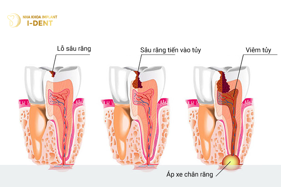 Viêm tủy do sâu răng 