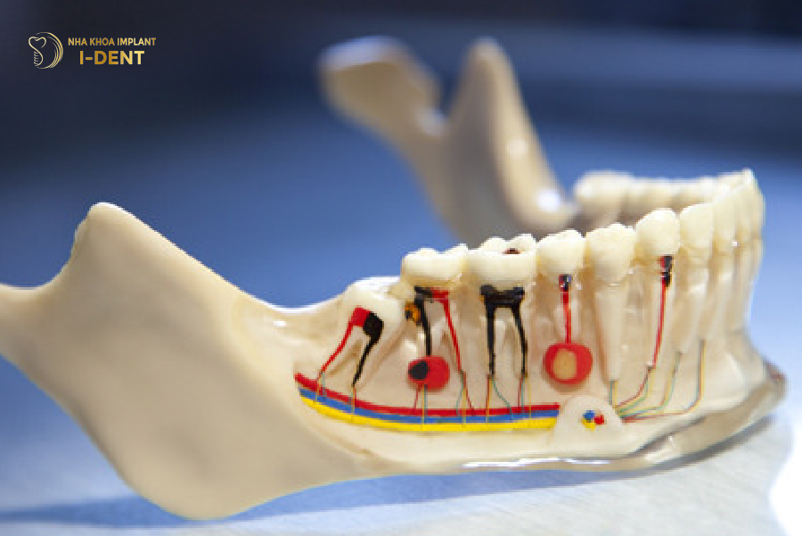 Viêm tủy gây đau nhức và buộc phải tháo răng sứ ra để điều trị