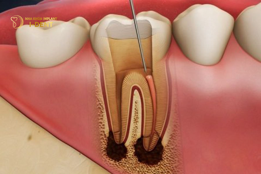 Trám răng lấy tủy bảo tồn răng thật