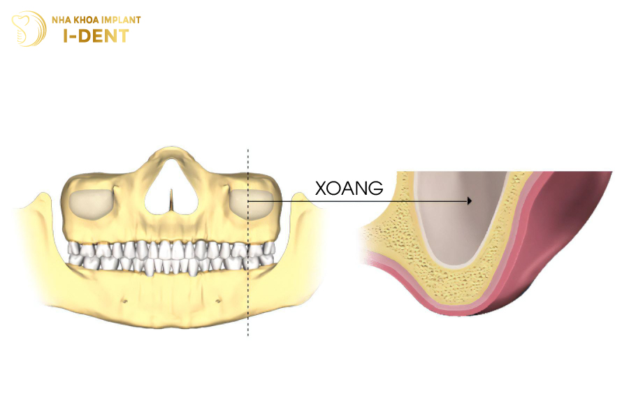 oang hàm bị tụt không quá sâu có thể thực hiện được nâng xoang kín