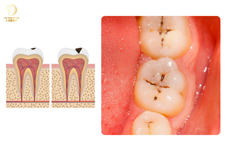 Dấu hiệu bị sâu răng xuất hiện các đốm đen trên bề mặt