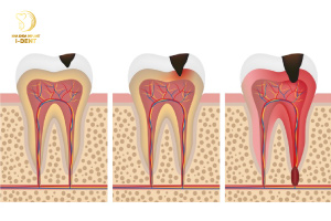 3 Mức Độ Sâu Răng Và Cách Xử Lý Bệnh Sâu Răng