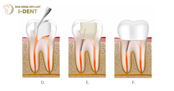 Bọc răng sứ cho răng sâu có nên không? Giá bao nhiêu?