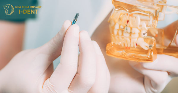 Cắm Răng Implant Mất Bao Lâu? Thời Gian Cấy Implant
