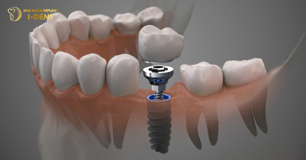 Trồng Răng Implant Mất Bao Lâu Tại Nha Khoa I-DENT