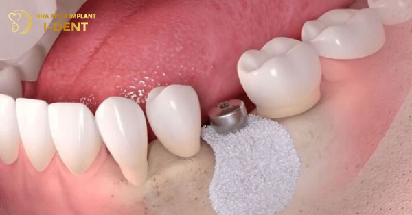 Phẫu Thuật Ghép Xương Răng Trong Cấy Ghép Implant