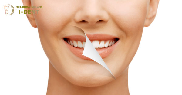 Bọc răng sứ có tẩy trắng được không? Cách làm như thế nào?