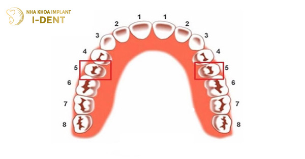 Nên trồng răng số 5 bằng phương pháp nào và giá bao nhiêu?