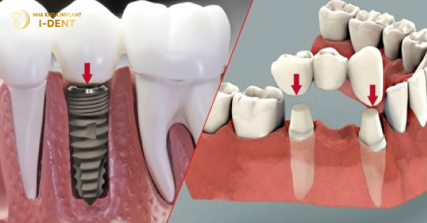 So Sánh Cầu Răng Sứ Và Implant Loại Nào Tốt?
