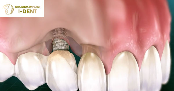 Trồng Răng Implant Giá Rẻ Có Tốt Không? Rủi Ro Cấy Ghép Implant Giá Rẻ