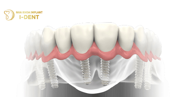 Trồng Răng Implant All On 6 - Khôi Phục Mất Răng Toàn Hàm Chuyên Dụng