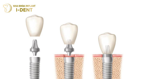 Phục hình răng sứ trên implant là gì? Quy trình như thế nào?