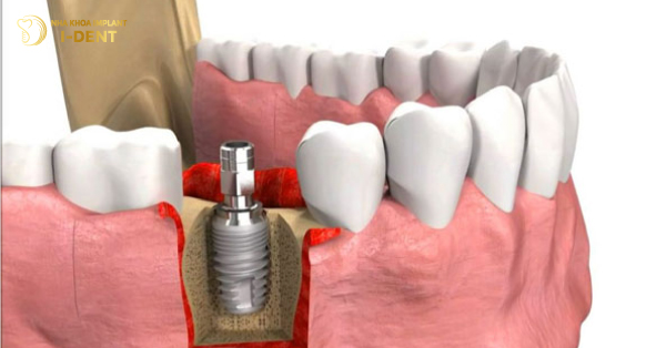 Trồng Răng Implant Bị Lung Lay Do Nguyên Nhân Nào?