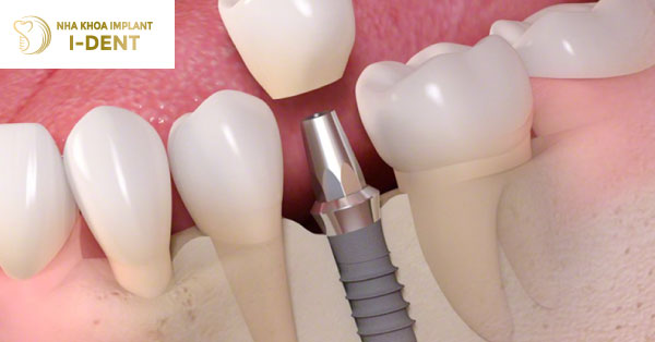 Răng Implant Có Tuổi Thọ Bao Lâu?