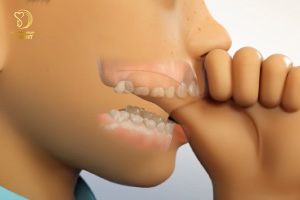 Vì Sao Mọc Răng Khểnh? Nên Hay Không Loại Bỏ Răng Khểnh
