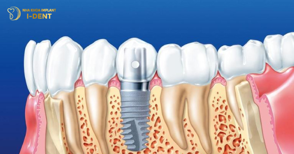 Tại Sao Cần Phải Trồng Răng Implant? 