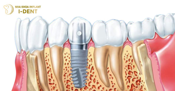 Phương Pháp Trồng Răng Implant Có Đau Không?