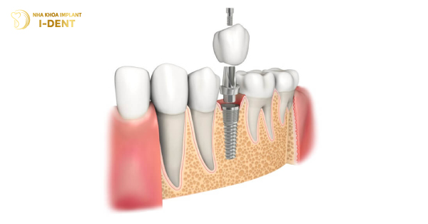 Trồng Răng Implant Sử Dụng Được Bao Lâu?