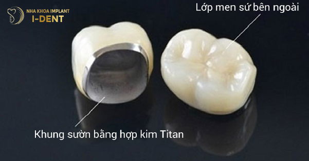Bọc Răng Sứ Titan Có Bị Đen Viền Nướu Không?